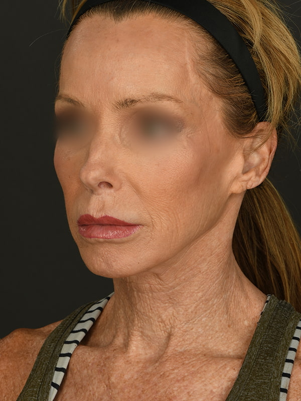 Face and Neck Lift Before & After Image
