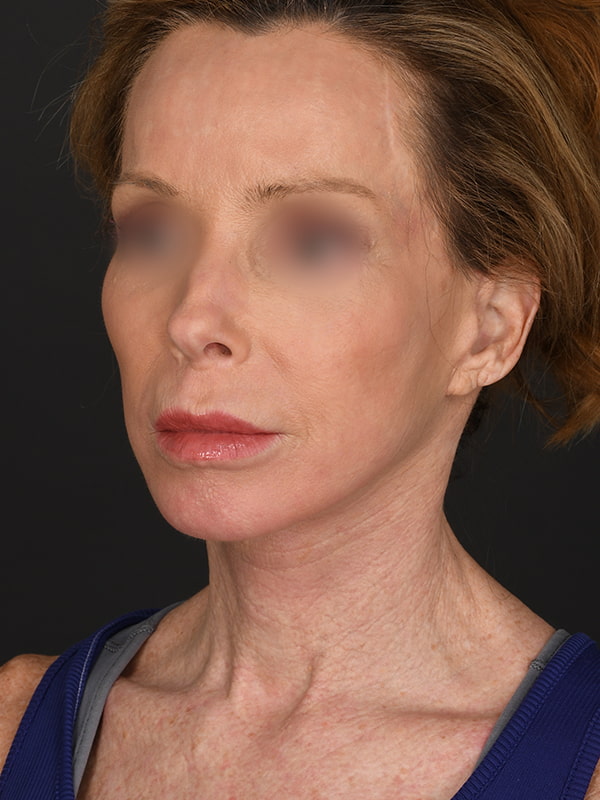 Face and Neck Lift Before & After Image
