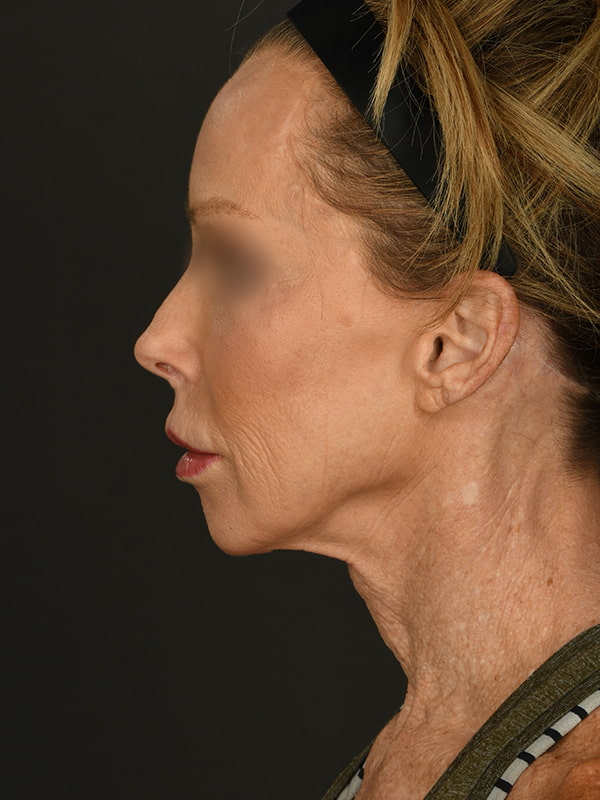 Face and Neck Lift Before & After Image