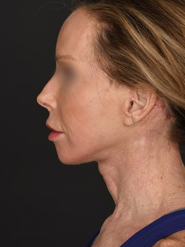 Face and Neck Lift Before & After Image