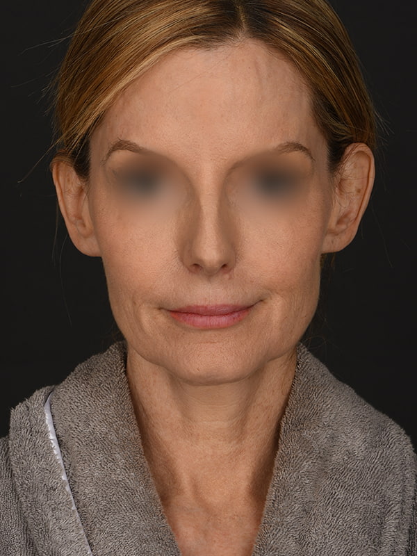 Face and Neck Lift Before & After Image