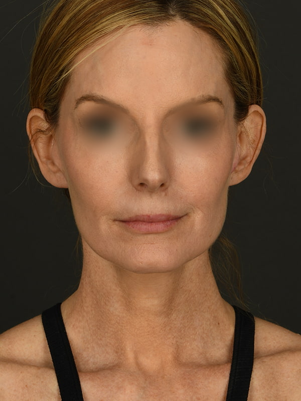 Face and Neck Lift Before & After Image