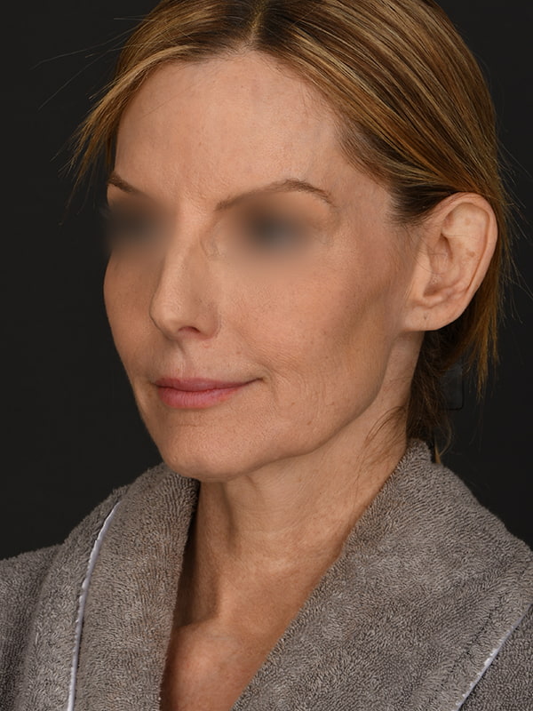 Face and Neck Lift Before & After Image
