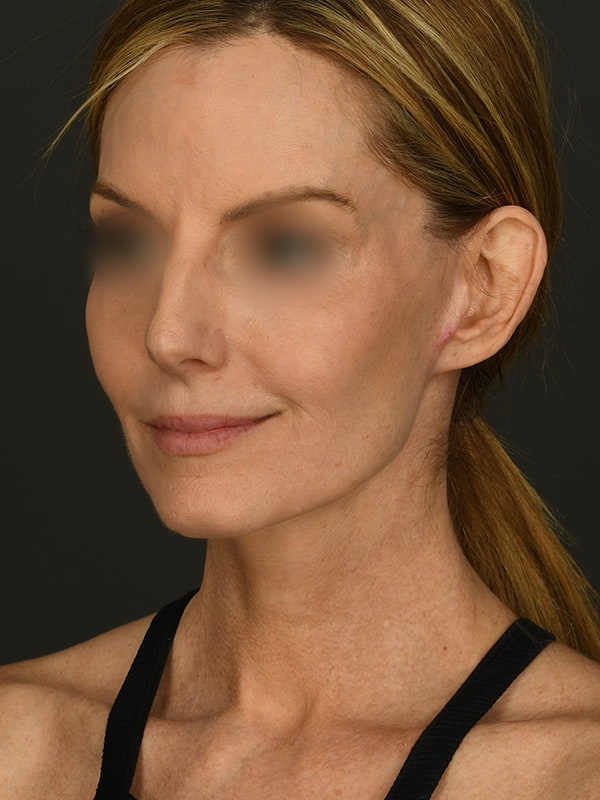 Face and Neck Lift Before & After Image
