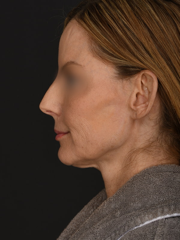 Face and Neck Lift Before & After Image