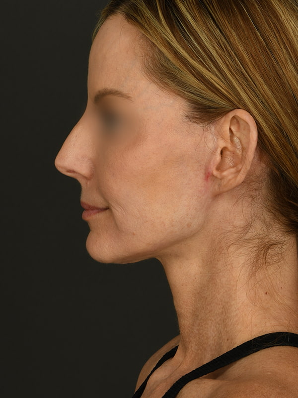 Face and Neck Lift Before & After Image