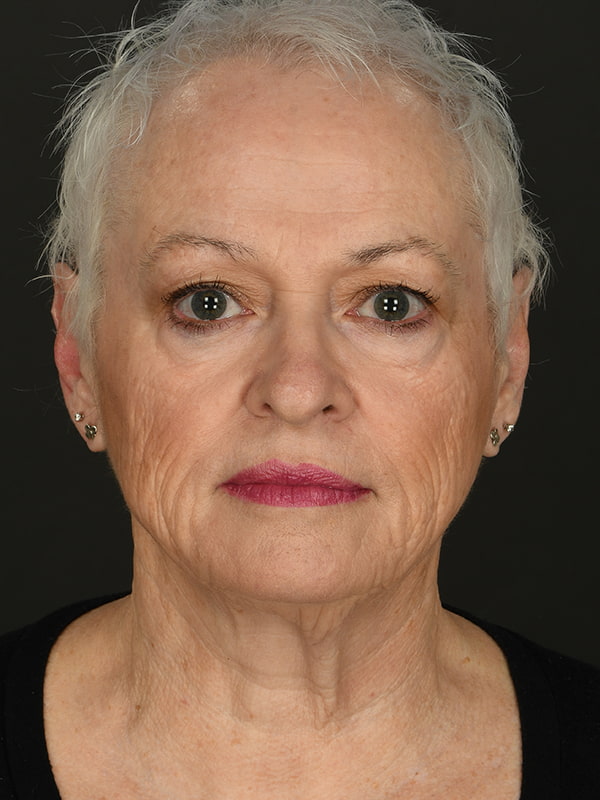 Face and Neck Lift Before & After Image