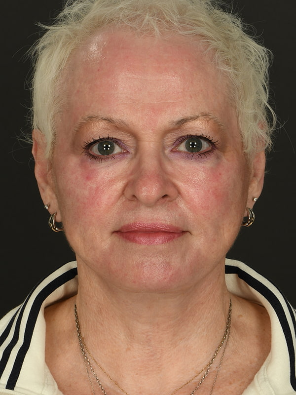 Face and Neck Lift Before & After Image