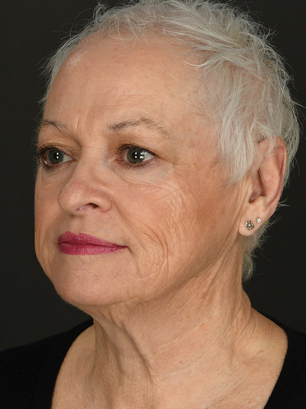 Face and Neck Lift Before & After Image
