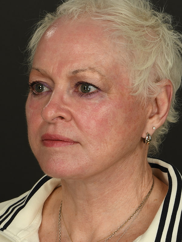 Face and Neck Lift Before & After Image