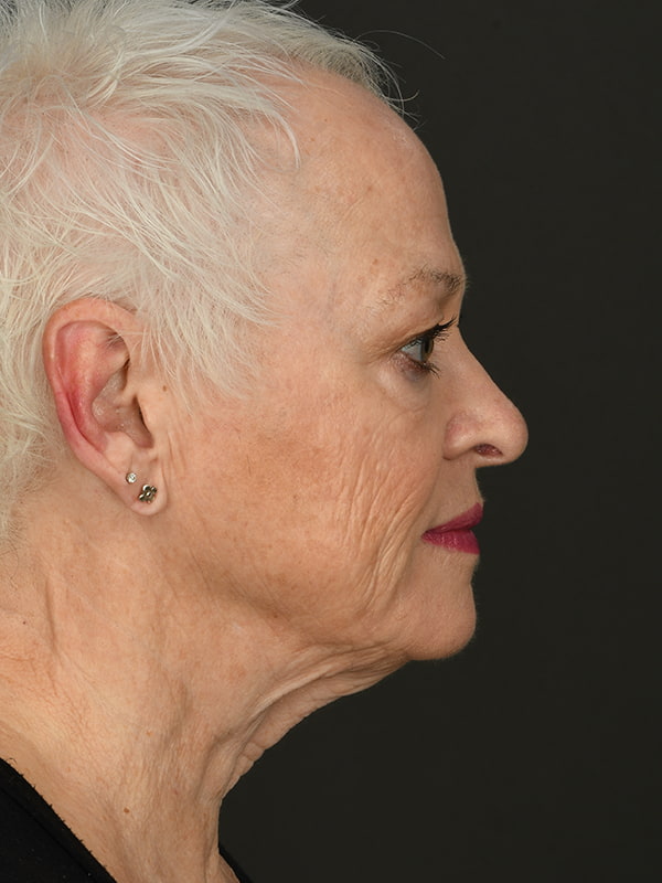 Face and Neck Lift Before & After Image
