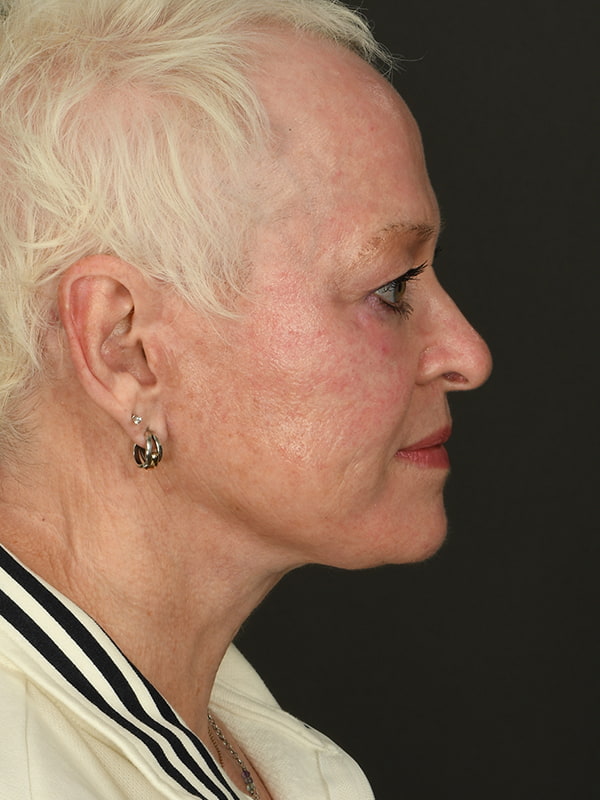 Face and Neck Lift Before & After Image