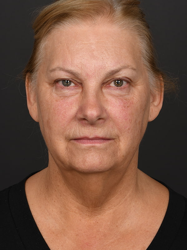Face and Neck Lift Before & After Image