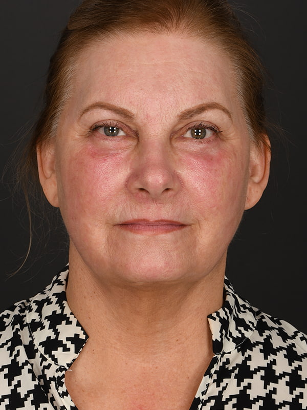 Face and Neck Lift Before & After Image