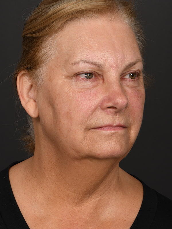 Face and Neck Lift Before & After Image