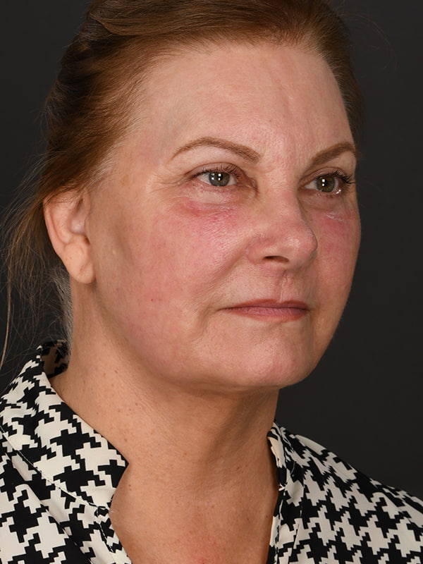 Face and Neck Lift Before & After Image