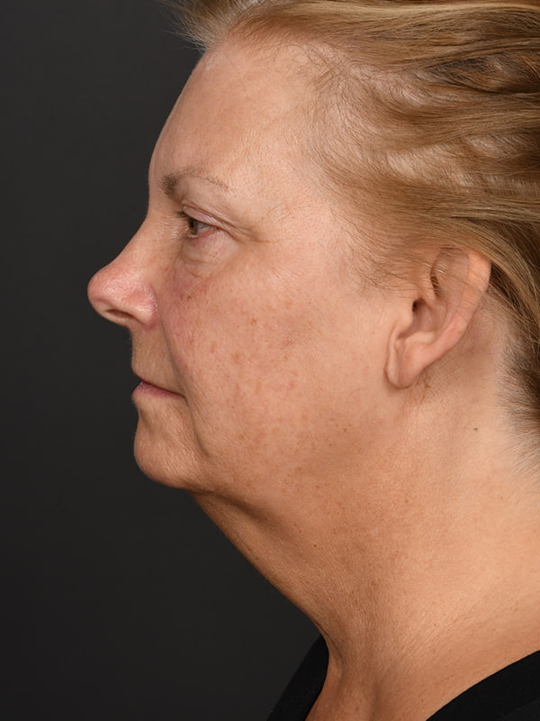 Face and Neck Lift Before & After Image