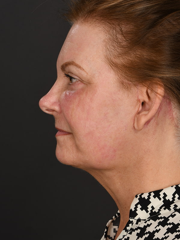 Face and Neck Lift Before & After Image