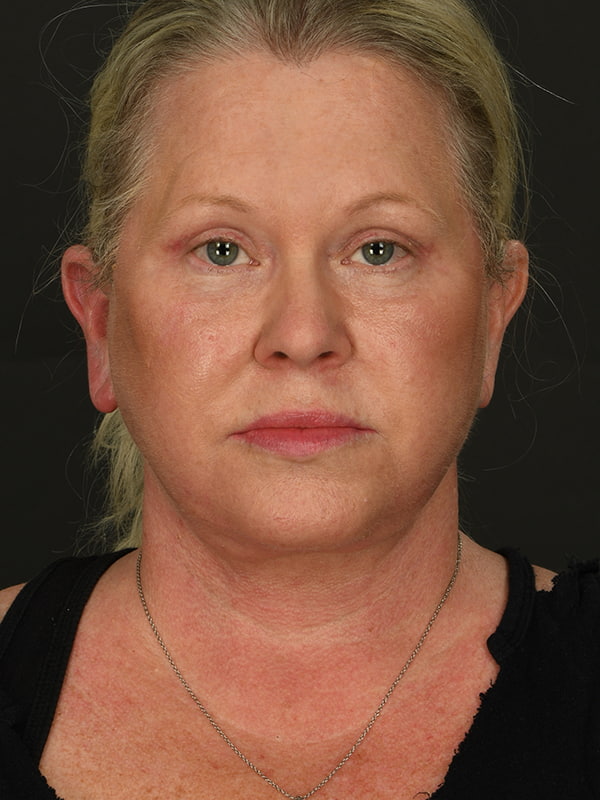 Face and Neck Lift Before & After Image