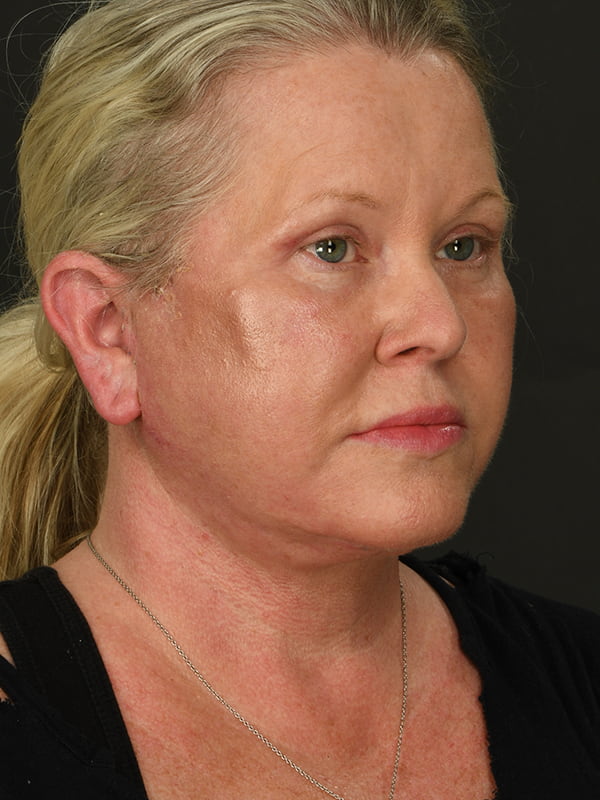 Face and Neck Lift Before & After Image