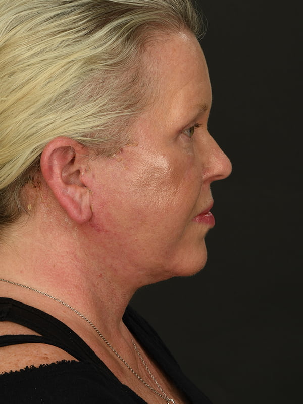Face and Neck Lift Before & After Image