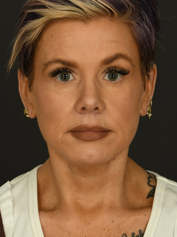 Face and Neck Lift Before & After Image