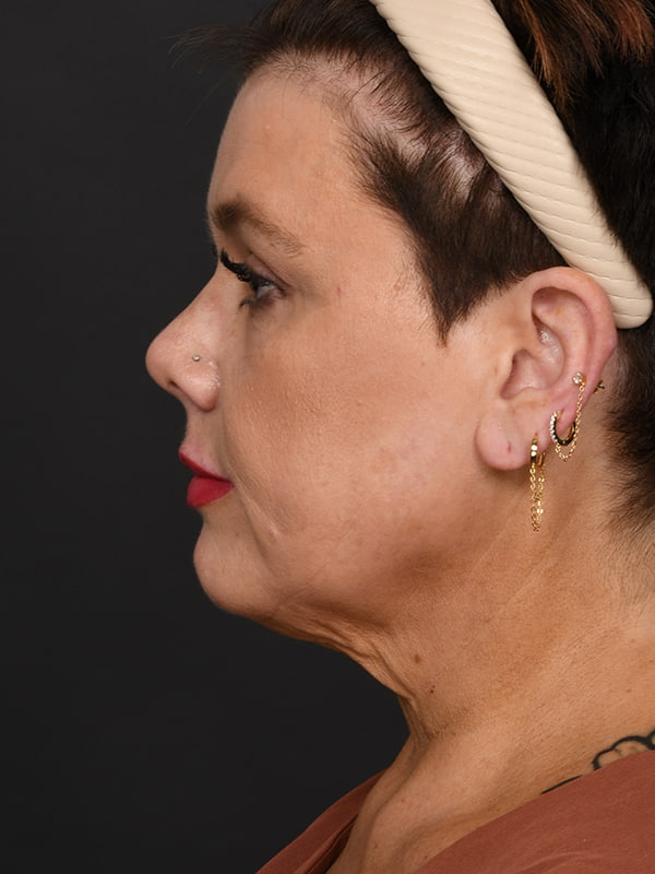 Face and Neck Lift Before & After Image