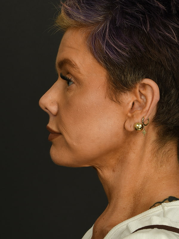 Face and Neck Lift Before & After Image