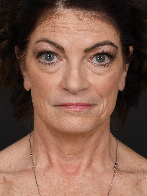 Face and Neck Lift Before & After Image