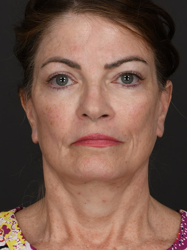 Face and Neck Lift Before & After Image