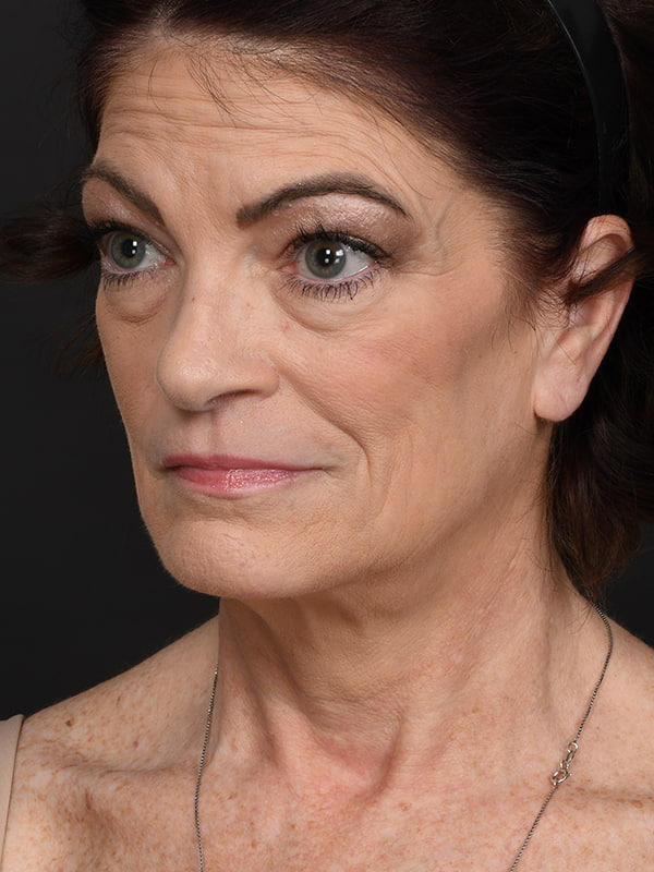 Face and Neck Lift Before & After Image