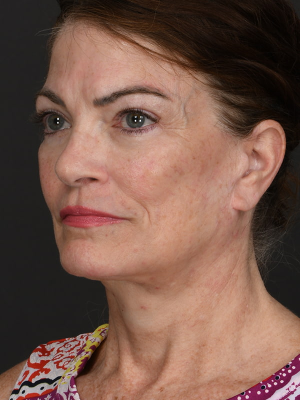 Face and Neck Lift Before & After Image