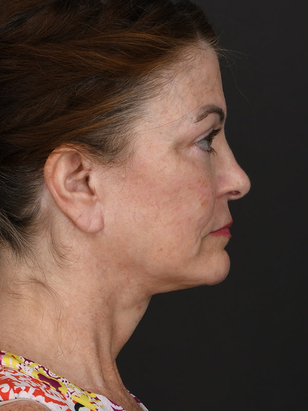 Face and Neck Lift Before & After Image
