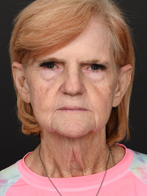 Face and Neck Lift Before & After Image