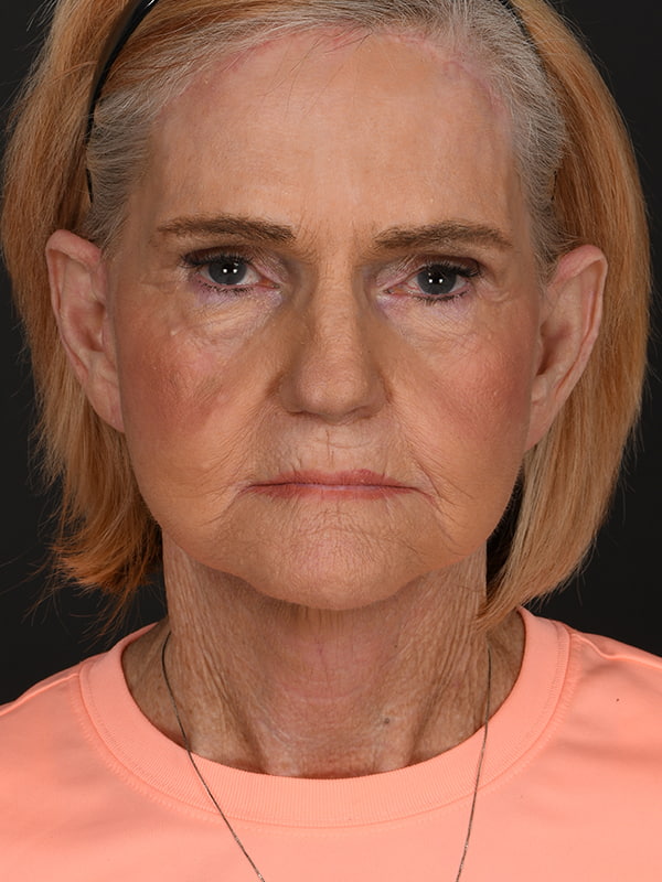 Face and Neck Lift Before & After Image