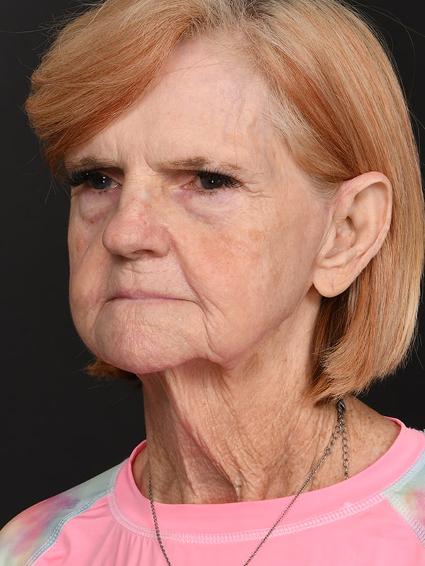 Face and Neck Lift Before & After Image