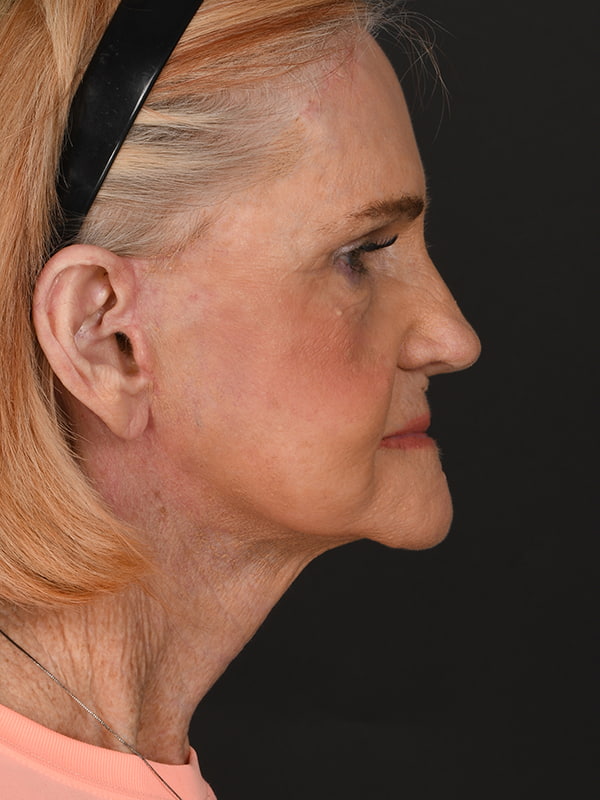 Face and Neck Lift Before & After Image
