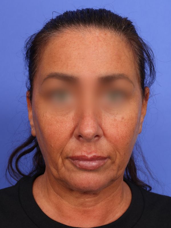 Face and Neck Lift Before & After Image
