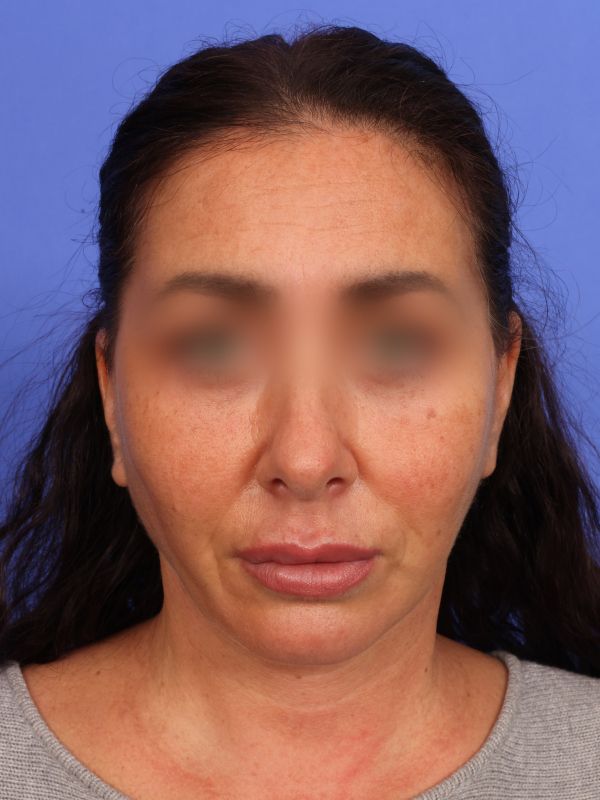 Face and Neck Lift Before & After Image