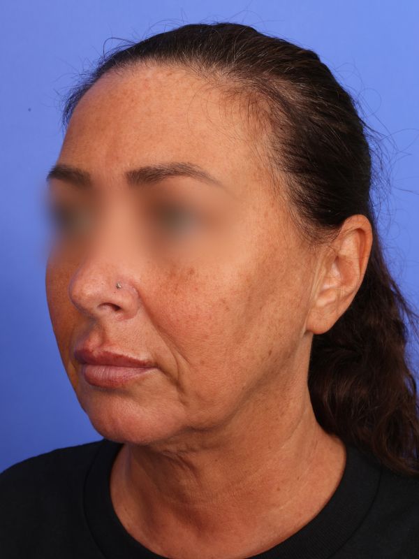 Face and Neck Lift Before & After Image