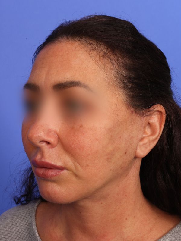 Face and Neck Lift Before & After Image