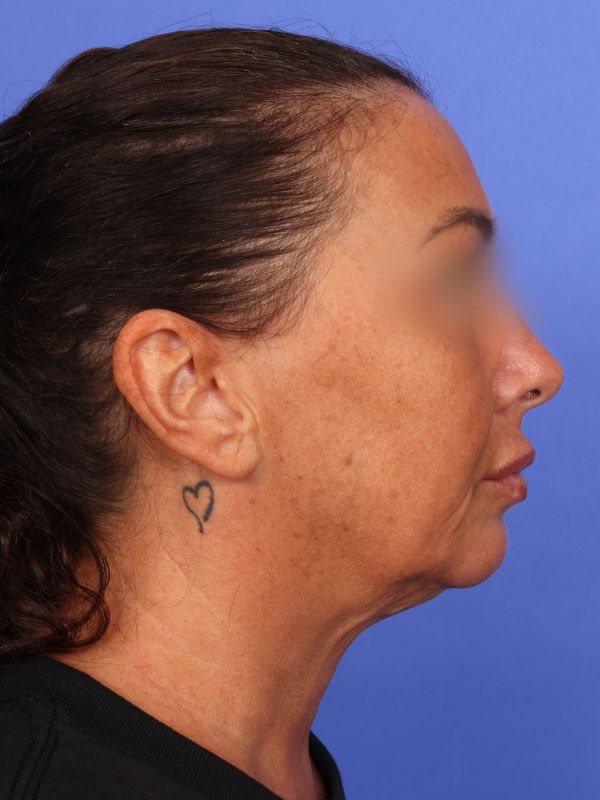 Face and Neck Lift Before & After Image