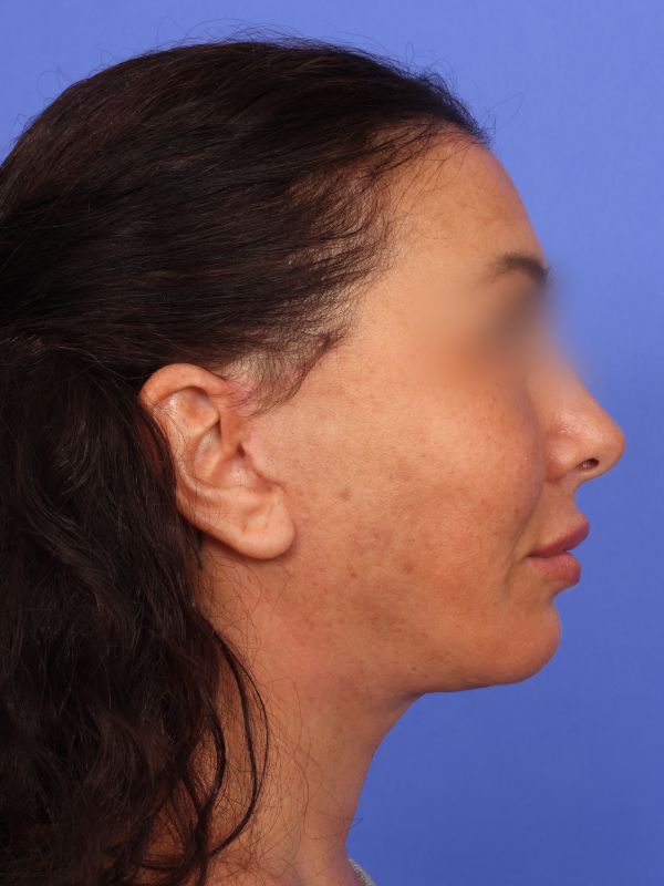 Face and Neck Lift Before & After Image