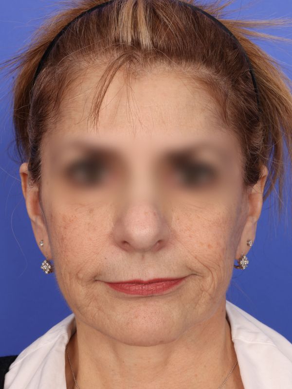 Face and Neck Lift Before & After Image