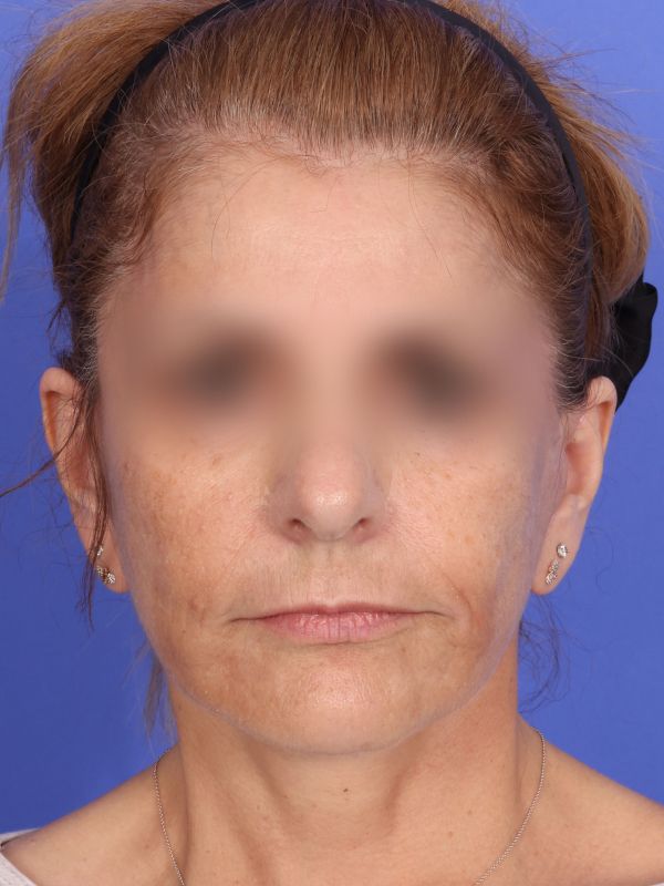 Face and Neck Lift Before & After Image