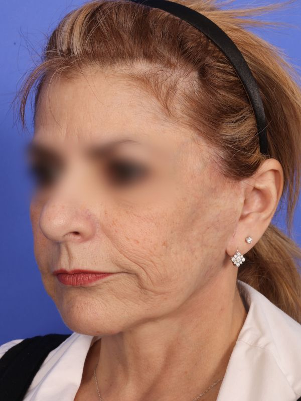 Face and Neck Lift Before & After Image