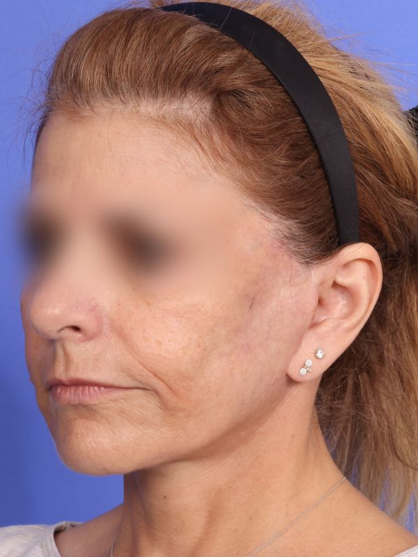 Face and Neck Lift Before & After Image