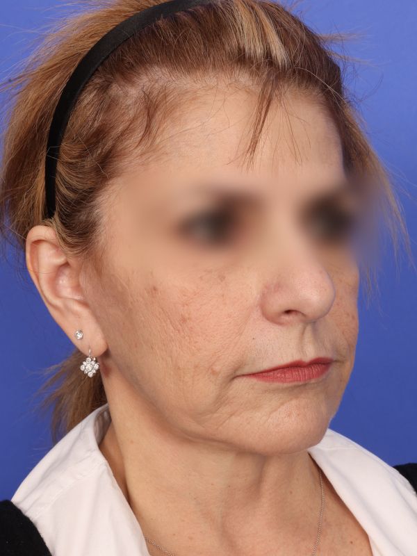Face and Neck Lift Before & After Image