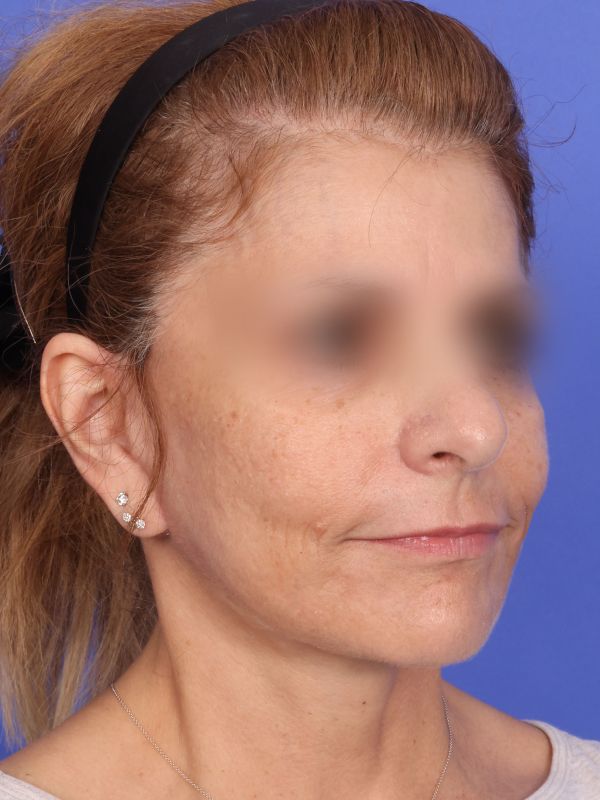 Face and Neck Lift Before & After Image