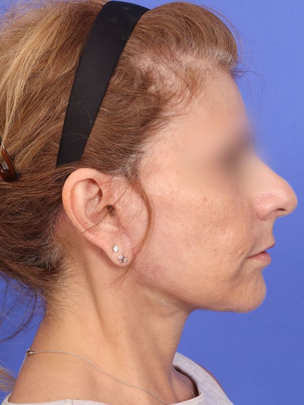 Face and Neck Lift Before & After Image
